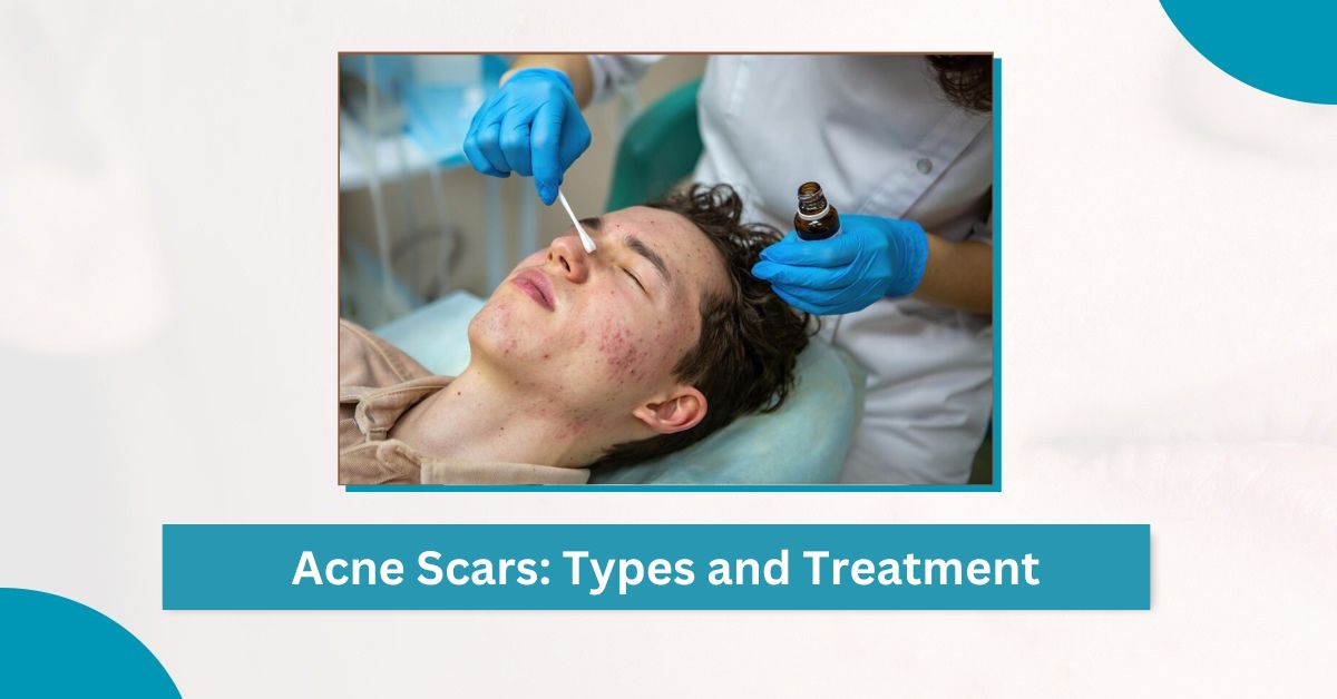 Acne Scars Treatment by Acne Specialist in Ludhiana