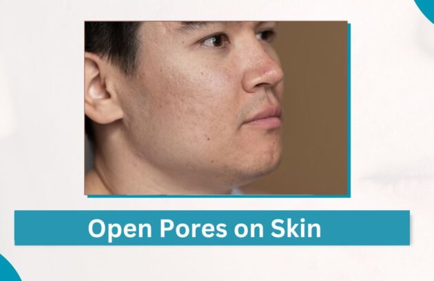 Open Pores On Skin